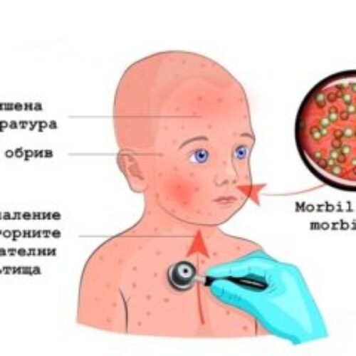 РЗИ – СЛИВЕН АЛАРМИРА: ВНИМАНИЕ, МОРБИЛИ!